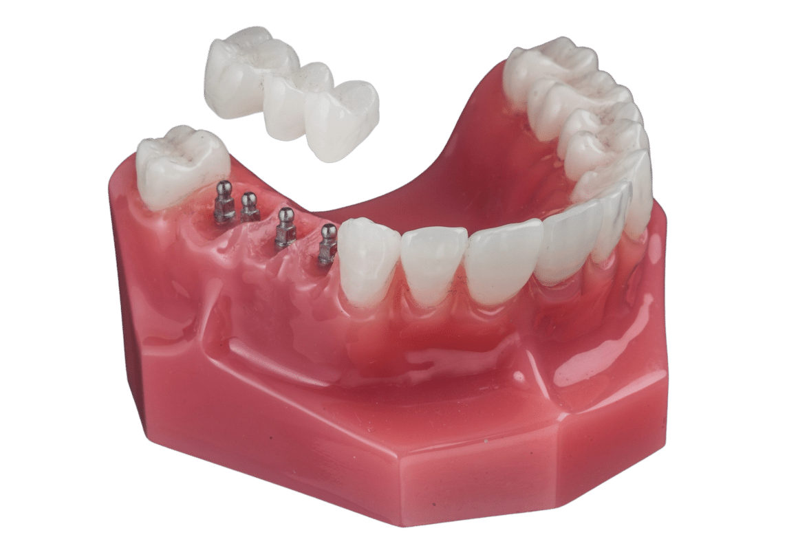 Dental Bridge in Syracuse, NY ImplantSupported Bridges