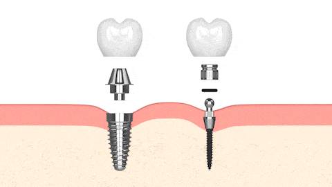 Implantes Dentales en Syracuse, NY