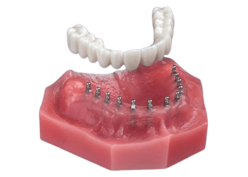 Dentures in Syracuse, NY - Implant Dentures in Syracuse, NY