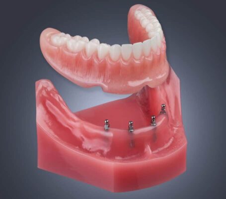 Implant Dentures in Syracuse, NY