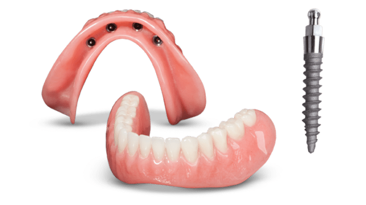 Dentaduras Snap-On en Syracuse, NY | Sobredentaduras | Mini Implantes