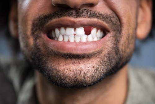 Missing Teeth in Syracuse, NY | Mini Dental Implants | Dr. Bradford