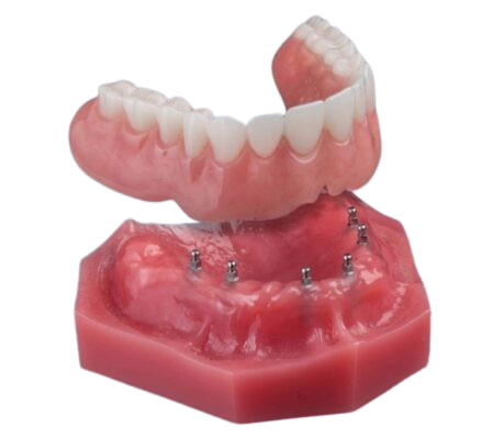 Overdentures in Syracuse, NY | Snap-On Dentures | Mini Implants
