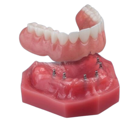 Overdentures in Syracuse, NY | Snap-On Dentures | Mini Implants