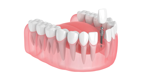 Dental Implant Treatment in Syracuse, NY | Tooth Replacement