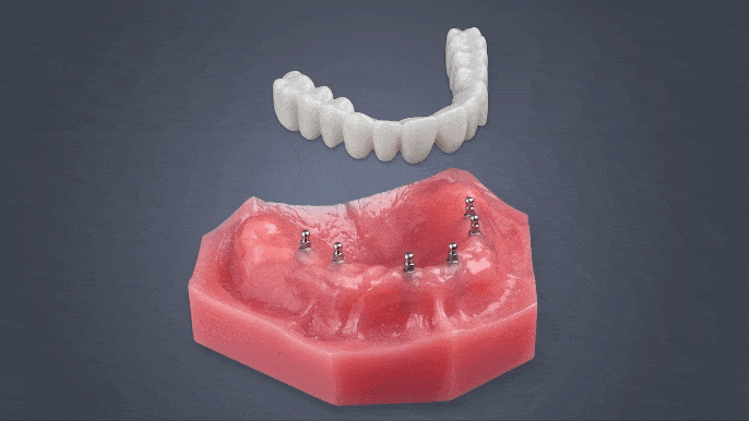 Fix-on-Six in Syracuse, NY | Mini Dental Implants | Dr. Bradford