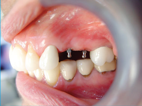 Implantes Dentales en Syracuse, NY | Mini Implantes Dentales