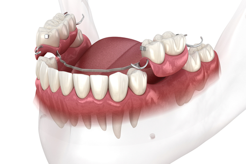 Partial Dentures in Syracuse, NY | Tooth Replacement Options