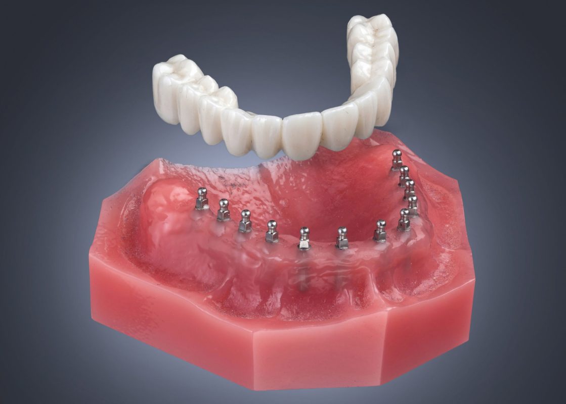 Mini Dentures in Syracuse, NY | Mini Dental Implants | Dr. Bradford