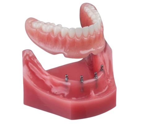 Snap-In Dentures in Syracuse, NY | Implant Denture | Mini Implants
