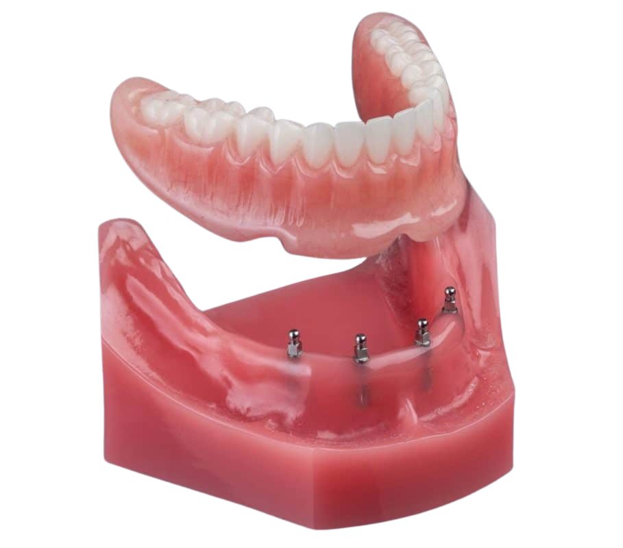 Snap-In Dentures in Syracuse, NY | Implant Denture | Mini Implants