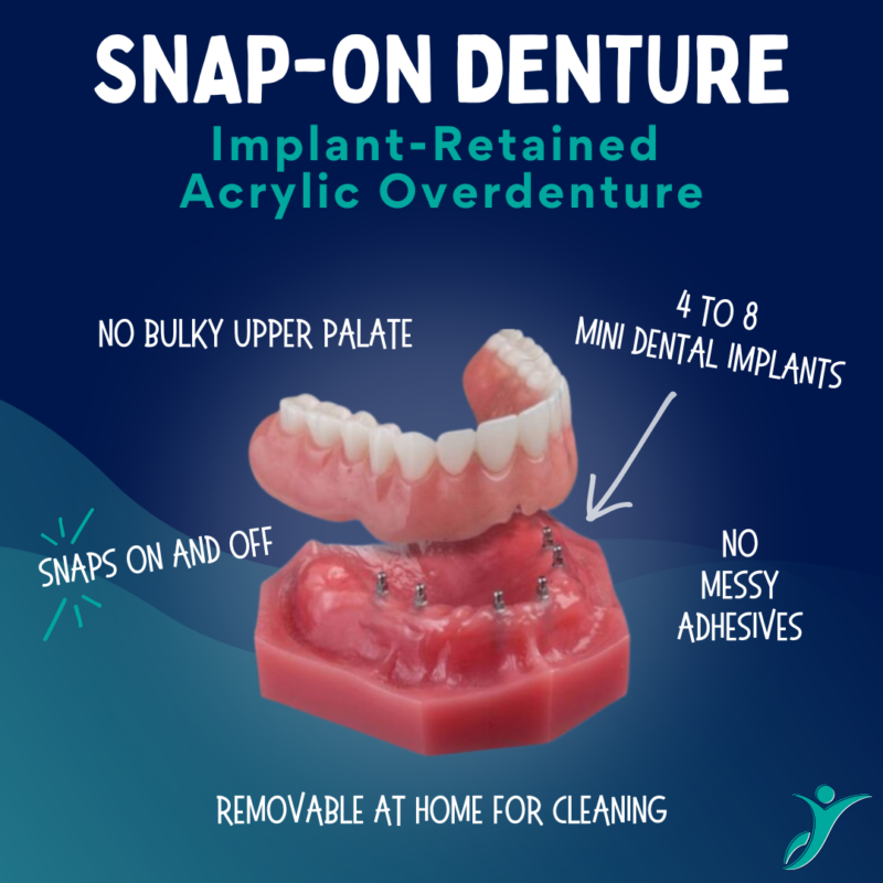 Implantes Dentales en Syracuse, NY Brent Bradford DDS
