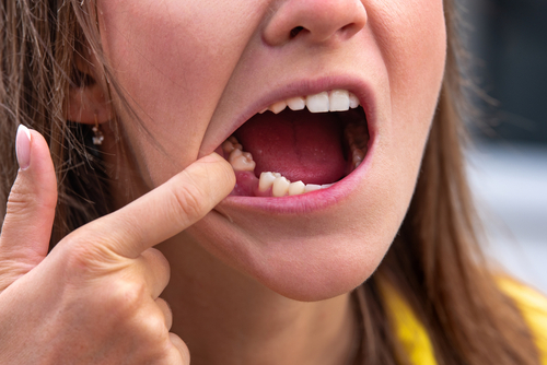 Tooth Replacement in Syracuse, NY | Mini Implants | New Teeth