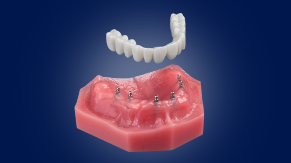 Denture Alternatives in Syracuse, NY | Mini Dental Implants