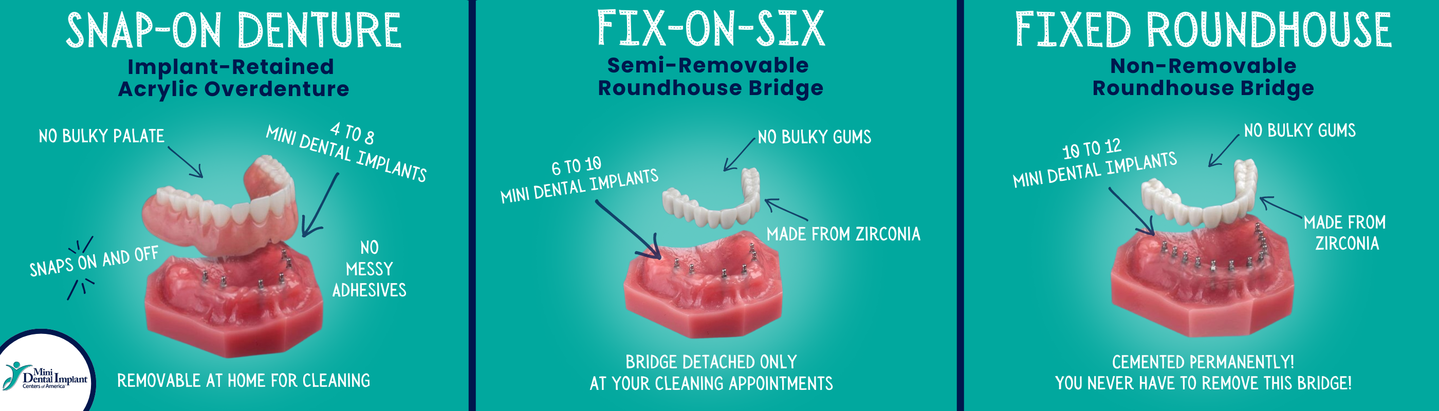 Denture Alternatives in Syracuse, NY | Mini Dental Implants