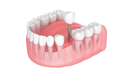 Non-Surgical Dental Implants in Syracuse, NY | Free Consultation