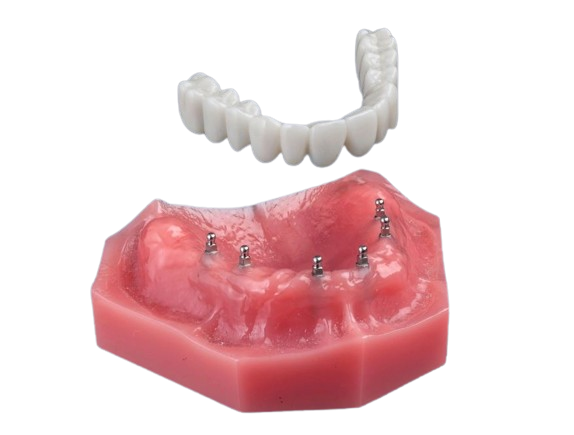 Opciones de prótesis en Syracuse, NY | Consultas gratuitas sobre prótesis de implantes