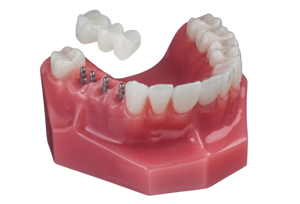 Implant Bridges [Video Demo] | Free Implant Consultations in NY