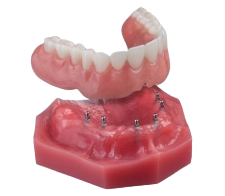 Dentaduras Estables en Syracuse, NY | Consultas de Implantes Gratis