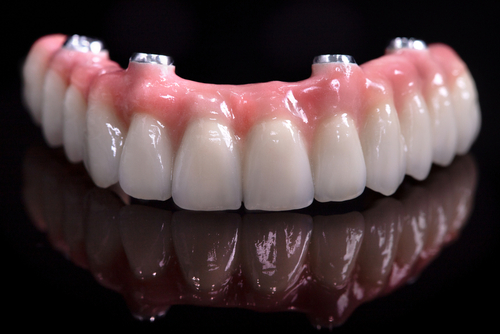 All-on-4 Alternatives in Syracuse, NY | Free Implant Consultations