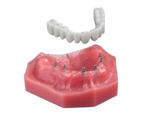 All-on-4 Alternatives in Syracuse, NY | Free Implant Consultations