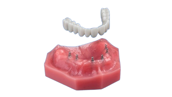 Dental Implant Denture in Syracuse, NY | Free Implant Consultation