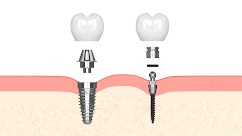What Are Mini Dental Implants in Syracuse, NY | Free Consultation