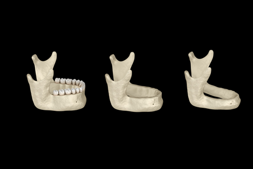 Implants and Dentures in Syracuse, NY The Hidden Cost of Traditional Dentures