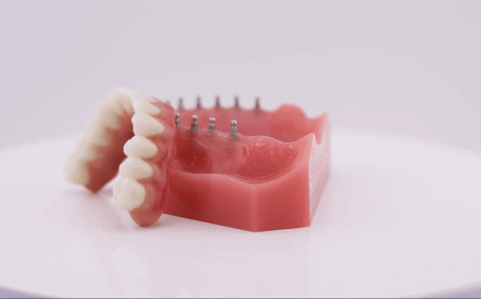 Implants and Dentures in Syracuse, NY | Use Implant Dentures To Secure Your Smile