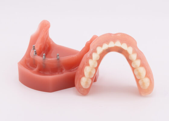 Lower Denture Implants [Video Guide] | Free Implant Consultations