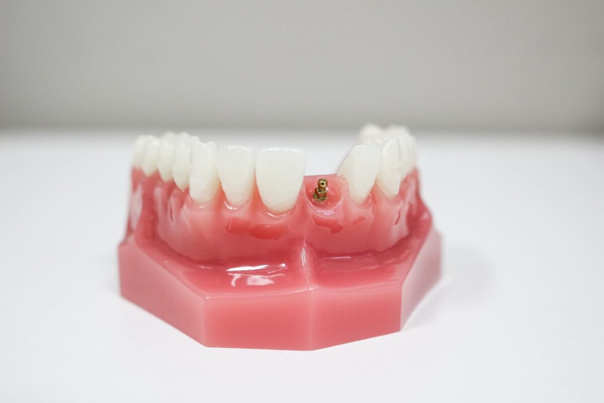 Implantes Dentales Asequibles en Syracuse, NY | Consultas Gratuitas