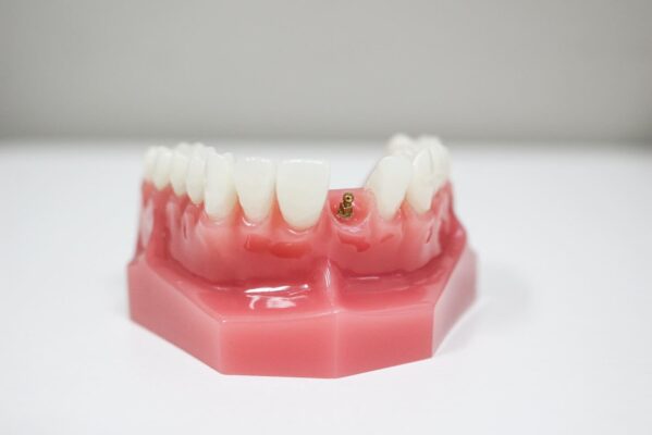 Affordable Teeth Implants in Syracuse, NY | Free Consultations
