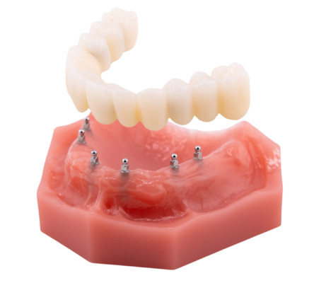 Implant Dentures in Liverpool, NY | Free Implant Consultations