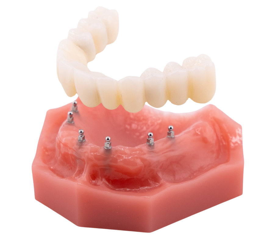 Dentaduras sobre implantes en Liverpool, NY | Consultas gratuitas sobre implantes