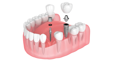 Most Affordable Dental Implants in Syracuse, NY | Mini Implants vs. Conventional Implants