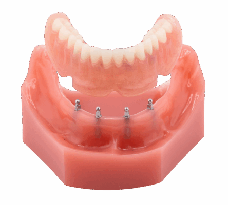 Snap On Denture in Syracuse, NY | Secure Your Smile Affordably