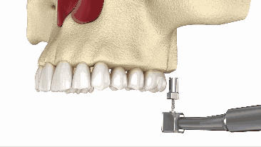 Sinus Lift in Syracuse, NY | Indirect Sinus Lift Process