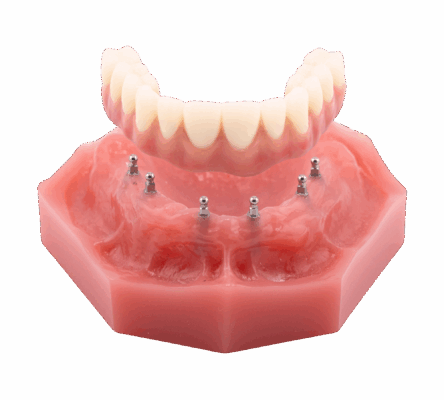 Dentaduras retenidas por implantes en Syracuse, NY | ¡Consultas gratis!