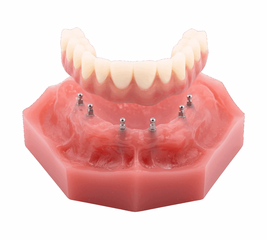 Implant Retained Dentures in Syracuse, NY | Free Consultations!
