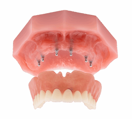 Full Mouth Dental Implants in Syracuse, NY | Explore Implant Denture Restorations