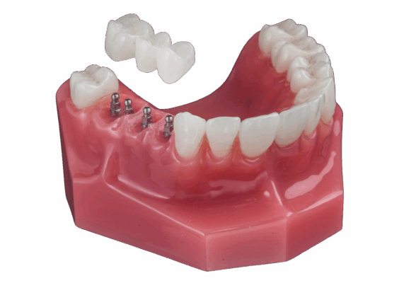 Is It Painful To Get a Dental Bridge | Free Implant Consultations in Syracuse, NY