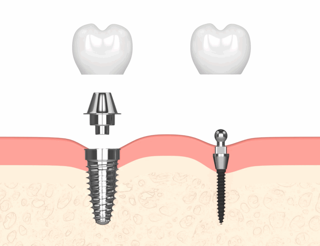 Implantes Dentales Asequibles en Liverpool, NY | Consultas Gratuitas de Implantes