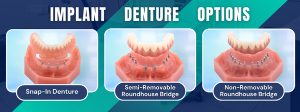 Implantes dentales de arco completo en Syracuse, NY | Sus opciones de prótesis de implantes