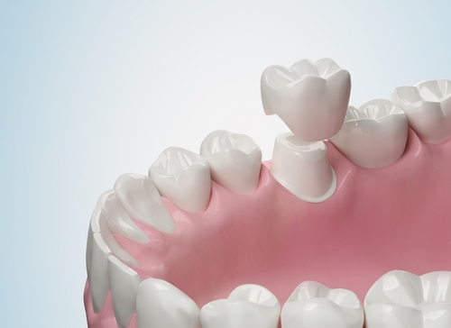Same-Day Crowns in Syracuse, NY | Fast & Effective Dental Care!