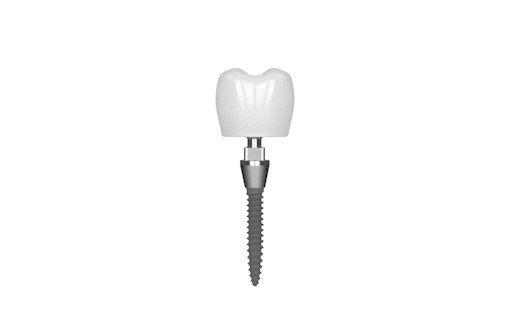 Miniimplantes dentales en Liverpool, Nueva York | [Vídeo explicativo]