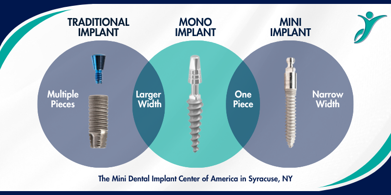 Tipos de implantes dentales [Vídeo explicativo] | Implantes dentales tradicionales, mini y mono