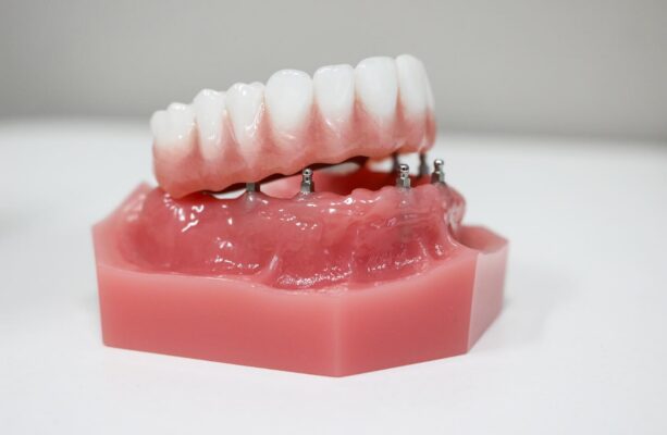 Full Mouth Restoration in Syracuse, NY | Free Implant Consultation