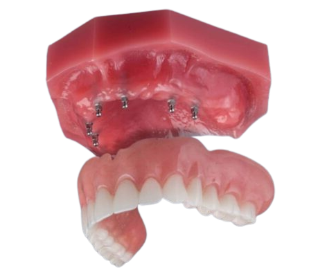 Upper Denture Implants in Syracuse, NY | Free Implant Consults